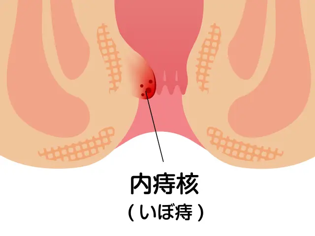 いぼ痔（痔核）-川崎市 高津区-溝の口の豊田クリニック