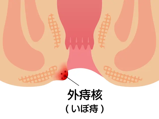 いぼ痔（痔核）-川崎市 高津区-溝の口の豊田クリニック